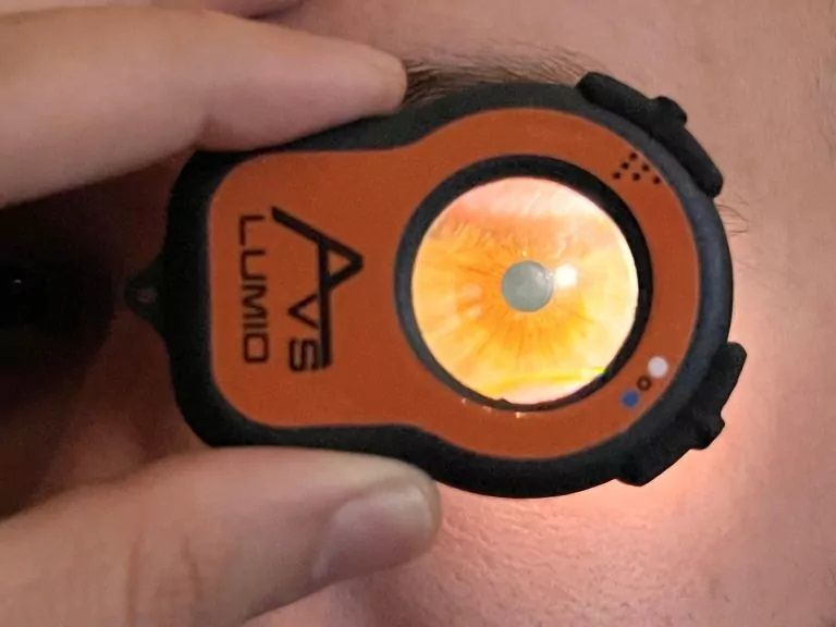 AVS Lumio Portable Anterior Eye Inspector